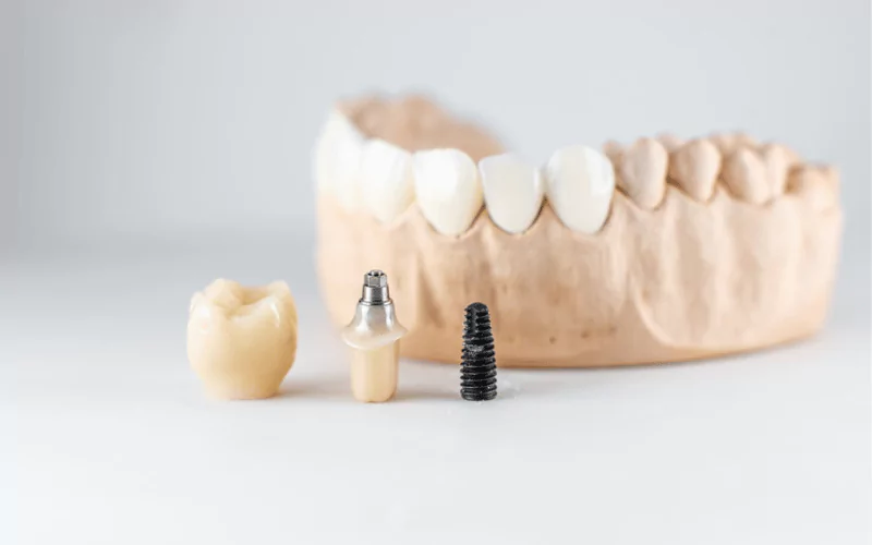 Do Dental Implants Get Cavities?
