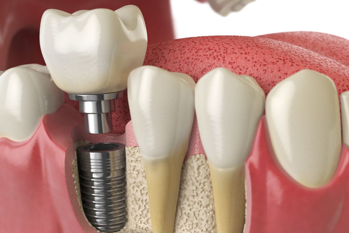 Afterlook of Dental Implant