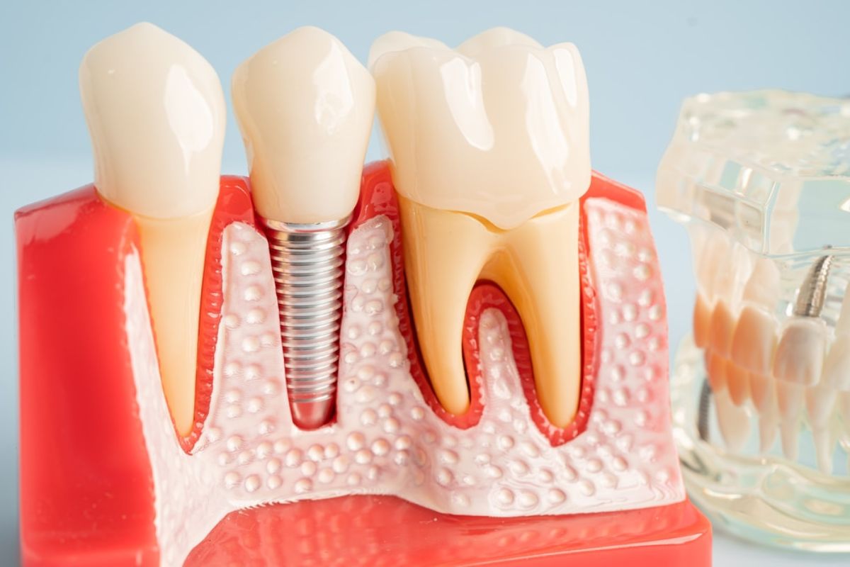 Dental Implants vs. Dentures & Bridges