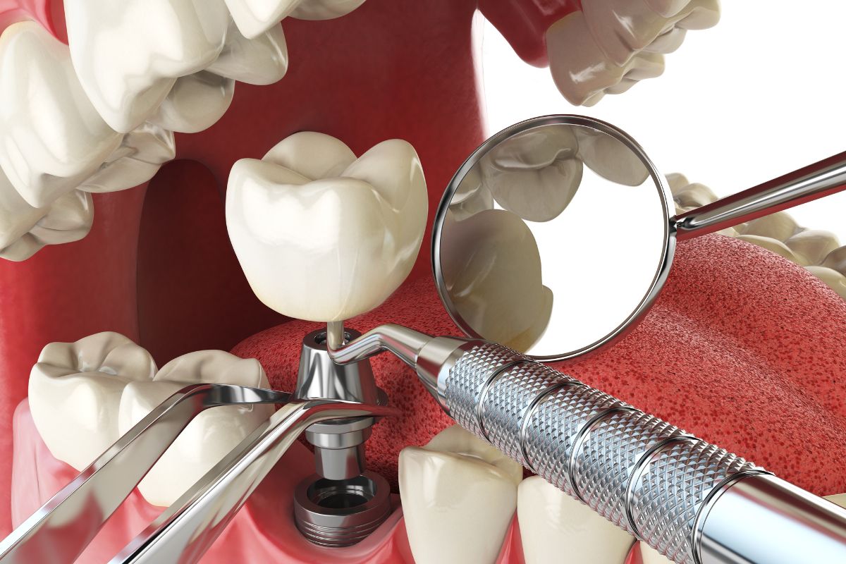 Daily Tips to Maintain Healthy Dental Implants for Life