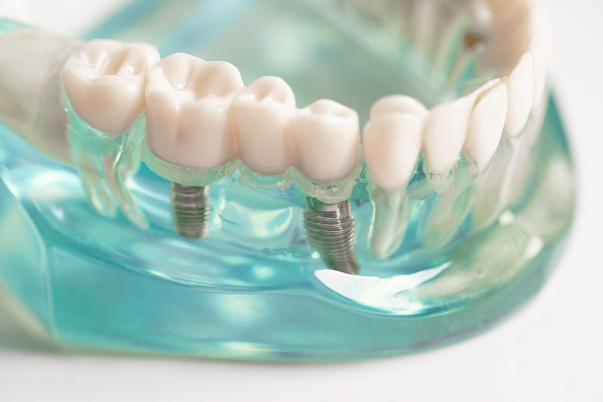 How Dental Implants Help Prevent Bone Loss in the Jaw