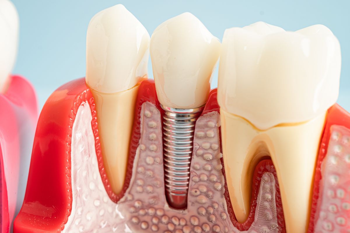 How Many Appointments Are Needed for Dental Implants Treatment?