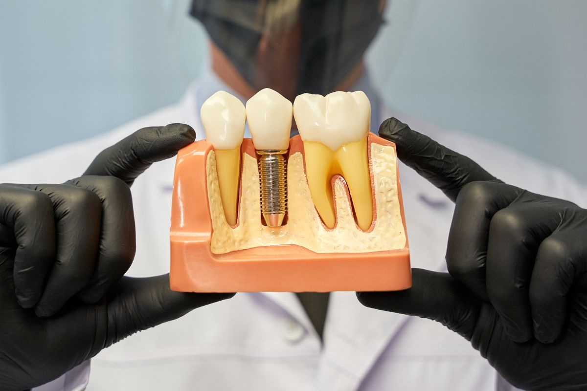 How Dentists Ensure Dental Implants Look Natural?