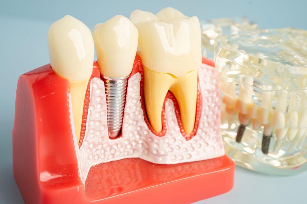 Best tooth replacement options implants vs dentures illustration
