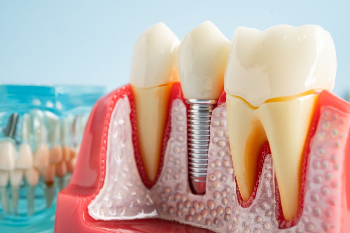 dental implant close-up model
