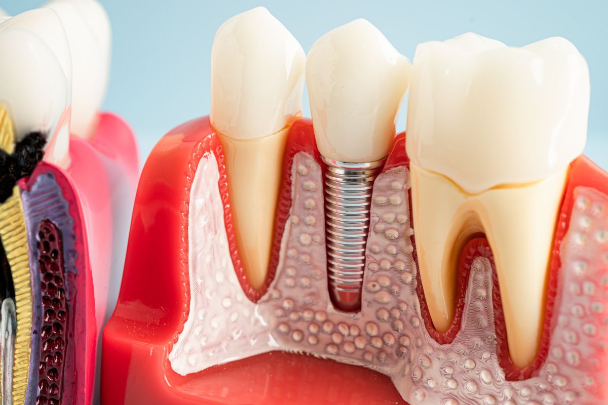 Close-up image of a dental implant for missing tooth replacement