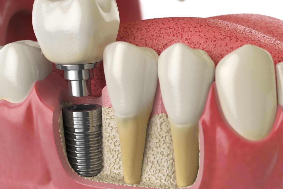 Dental implant illustration showing titanium screw fixture in jawbone with crown restoration.