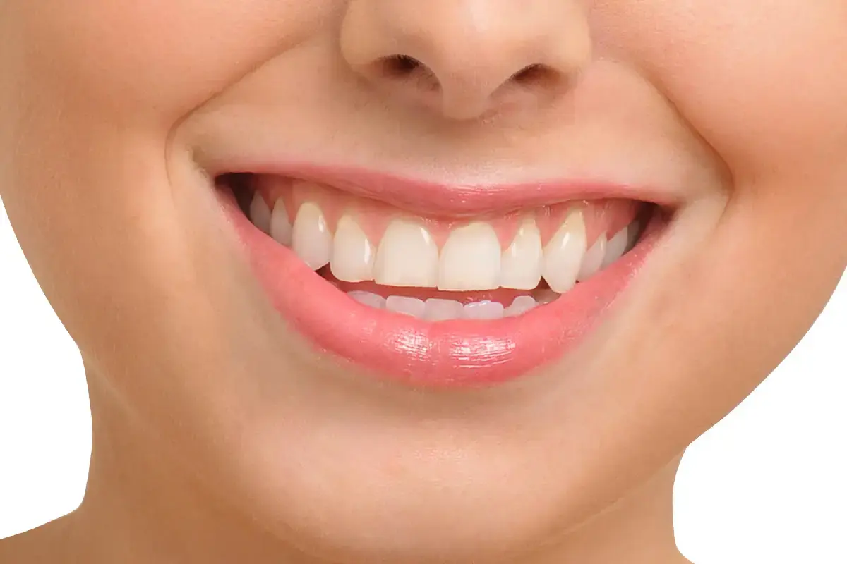 Close-up of a patient's bright white smile showing healthy teeth and pink gums.