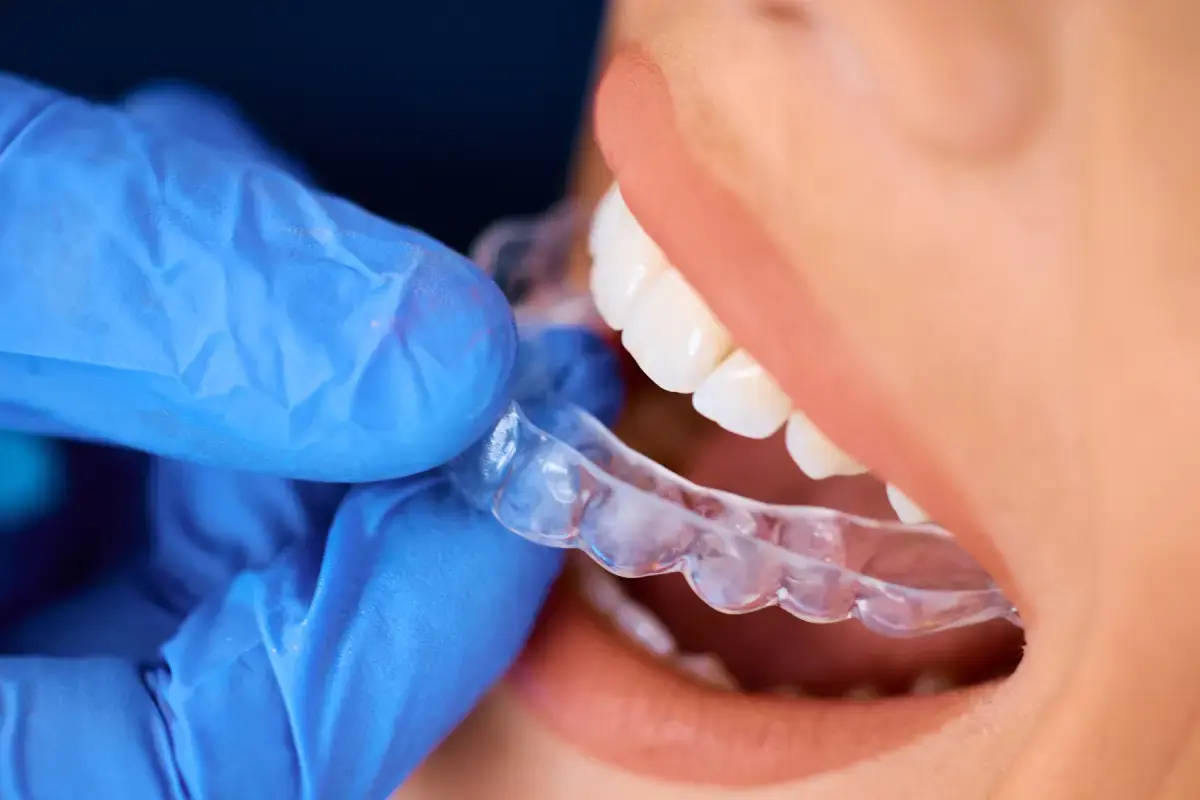 Dentist fitting clear aligner tray on patient's teeth during adult orthodontic treatment.
